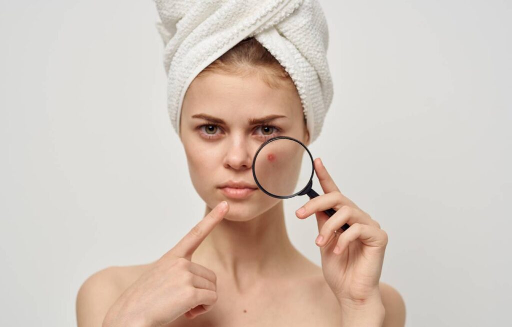 Acne-Skincare-Tips
